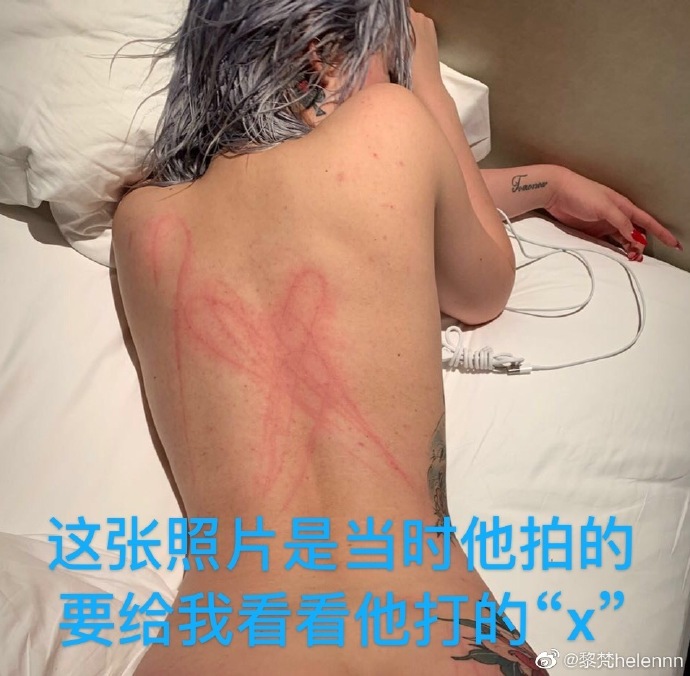 有特殊癖好还打人？疑屈楚萧女友晒伤照 自曝流